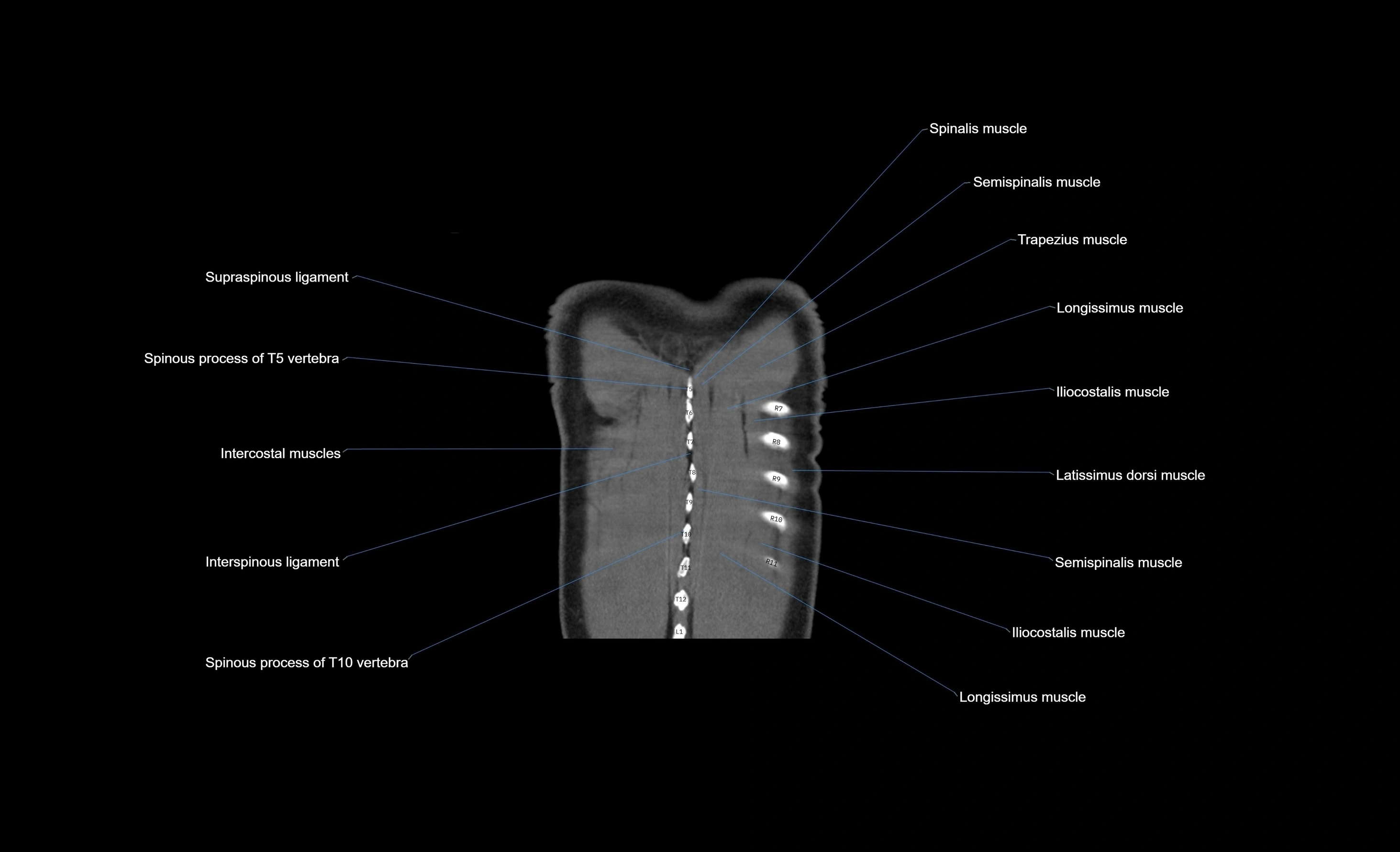CT chest (thorax) soft tissue window labelled coronal cross sectional anatomy radiology image-00009.webp
